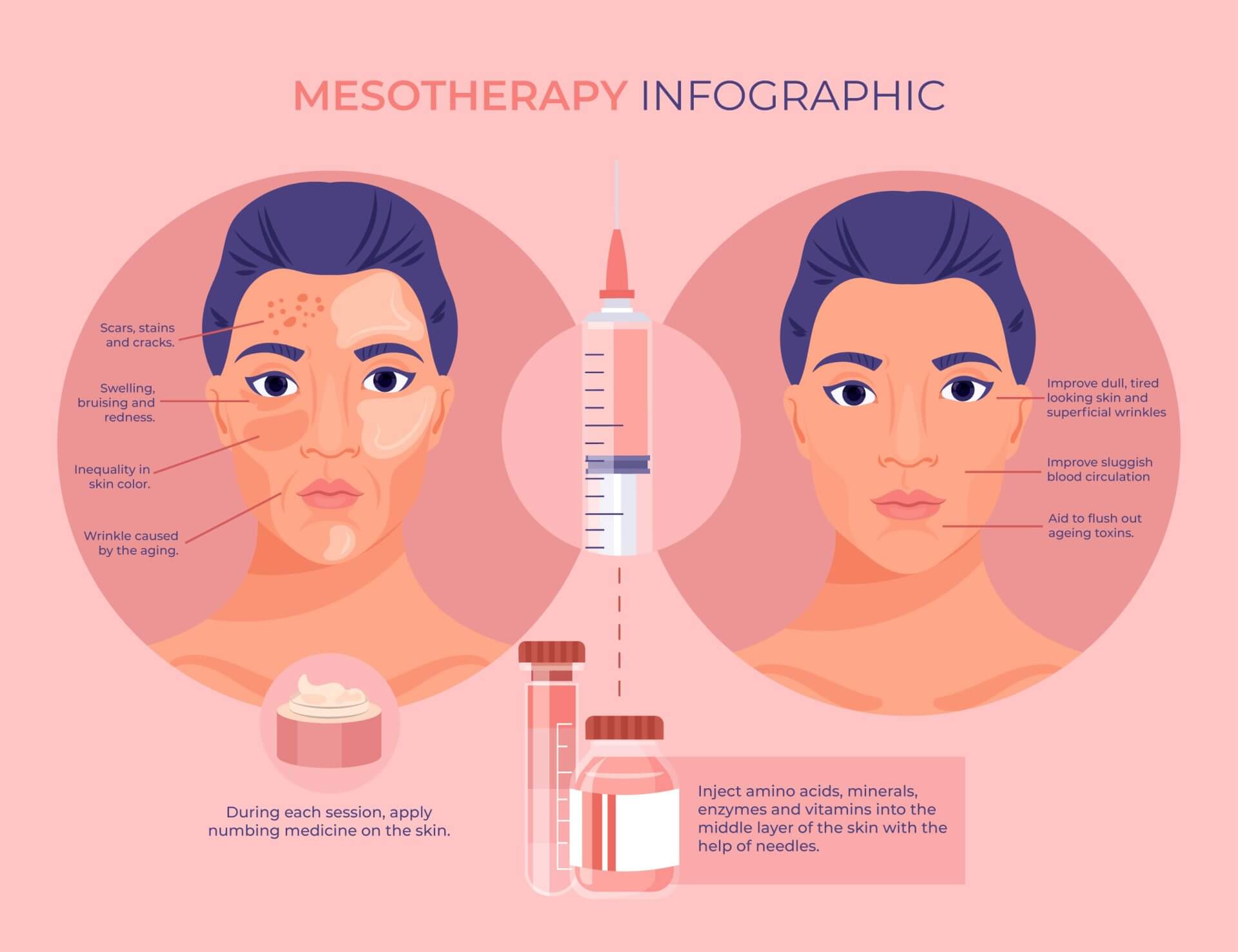 mesotherapy infographic