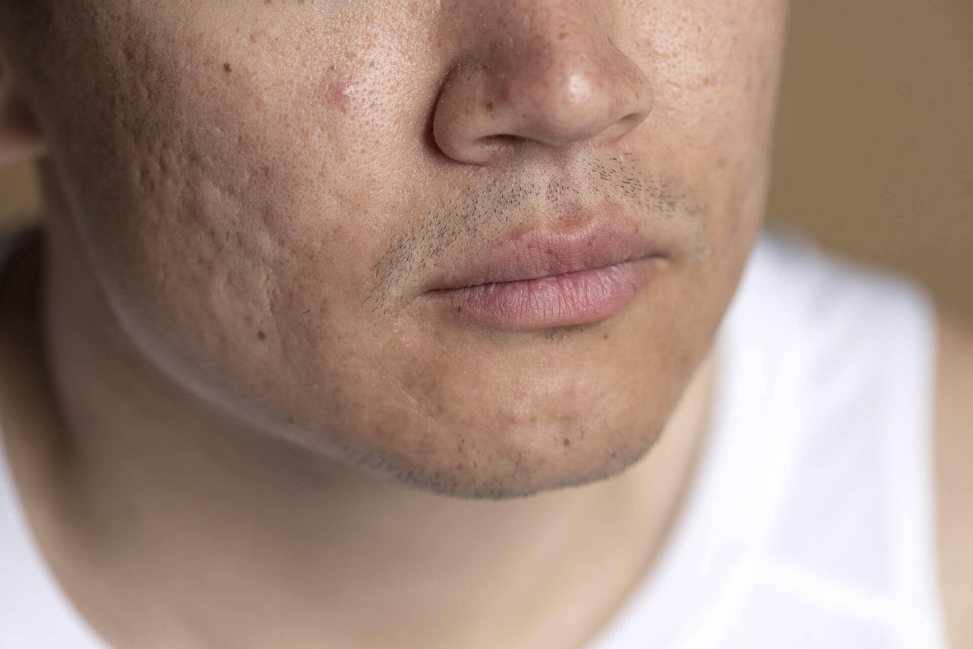 acne scars on face