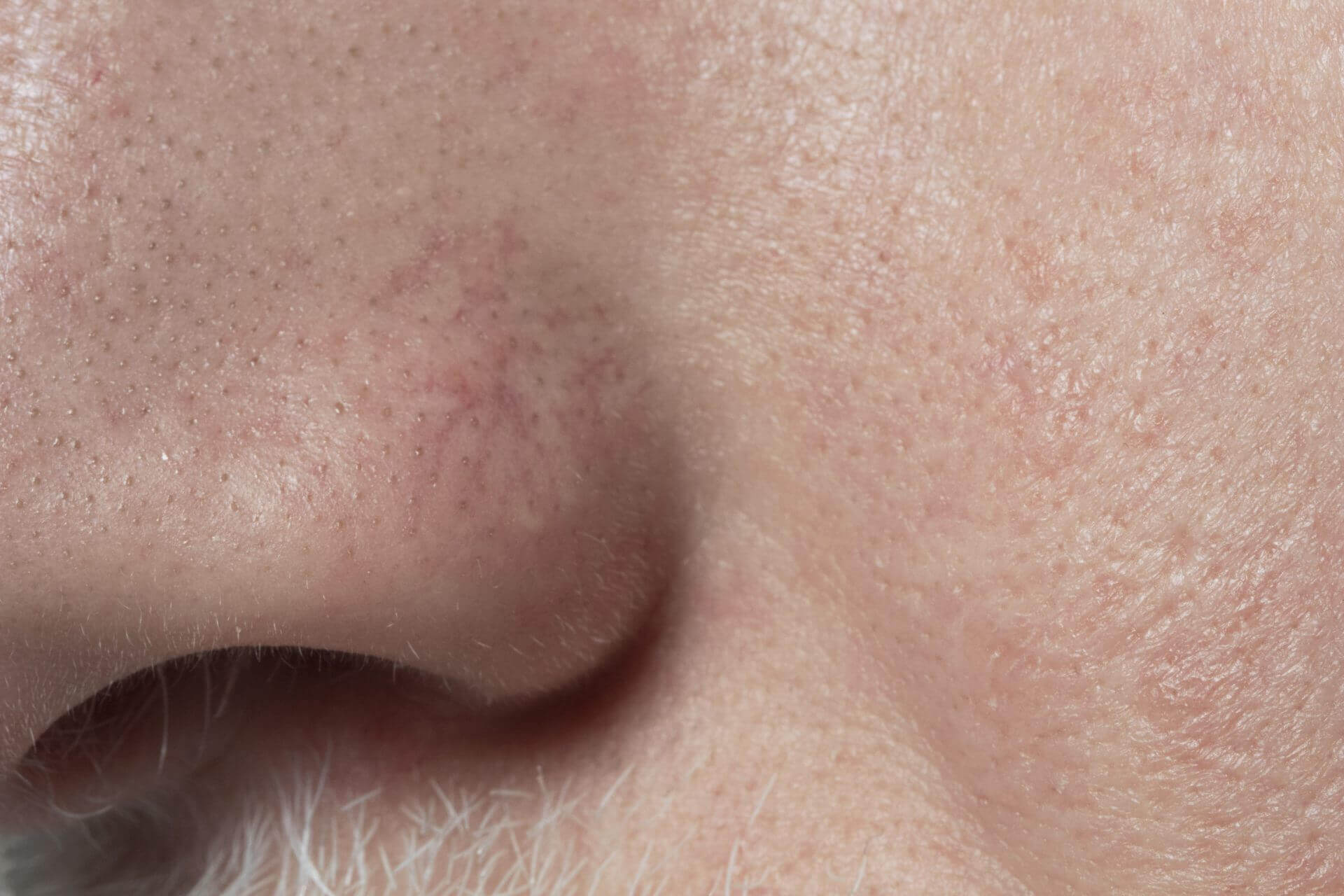 blackheads on nose