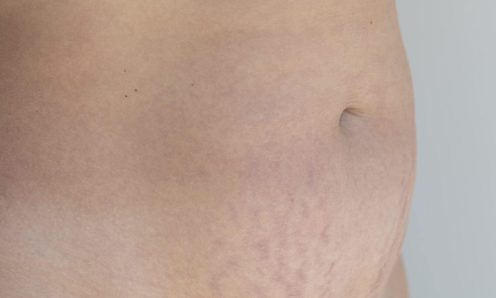 stretch marks on stomach