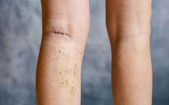 phlebecotomy for varicose veins