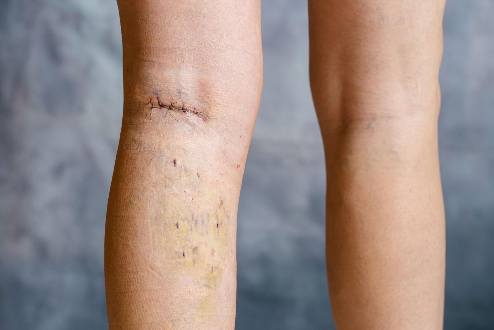 phlebectomy for varicose veins