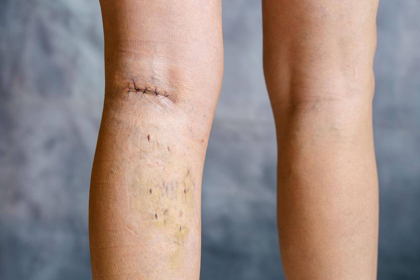 phlebecotomy for varicose veins