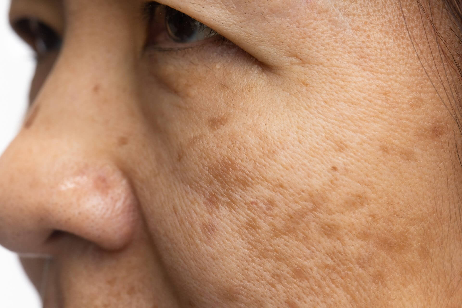 pigmentation spots on face