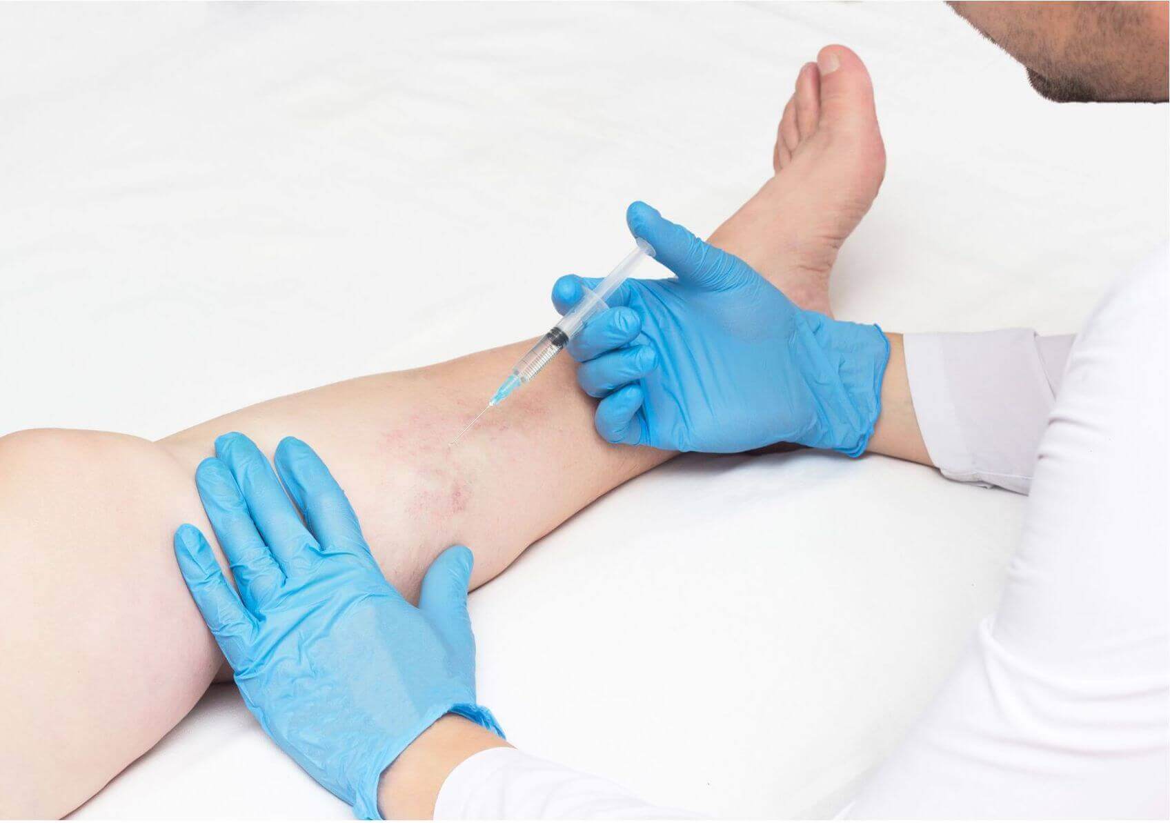 sclerotherapy