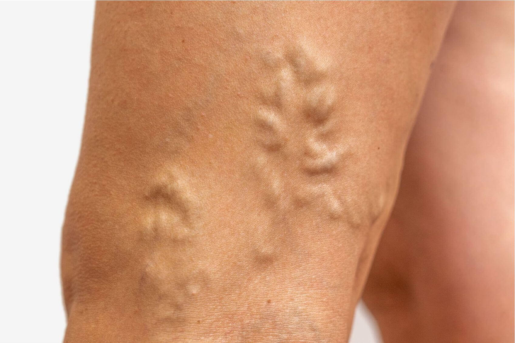 what are varicose veins