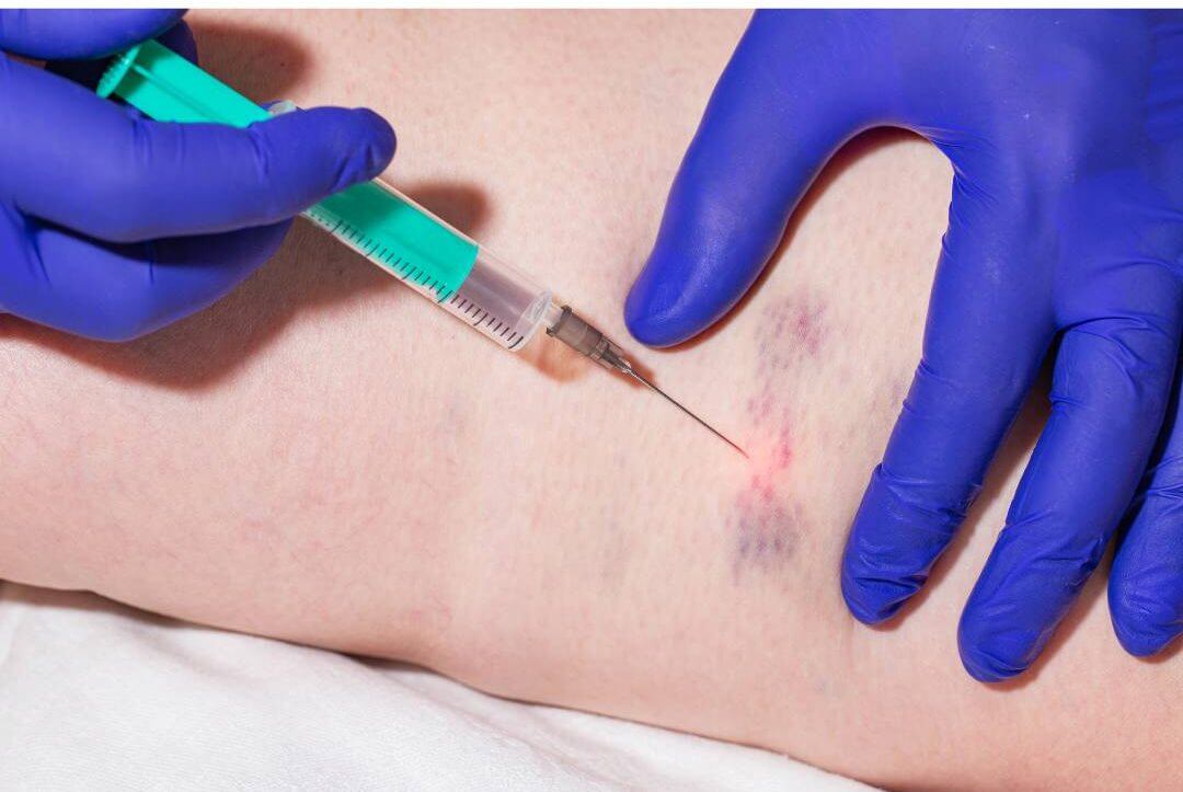 injecting into vein sclerotherapy