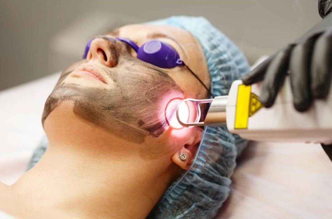 laser resurfacing in summer