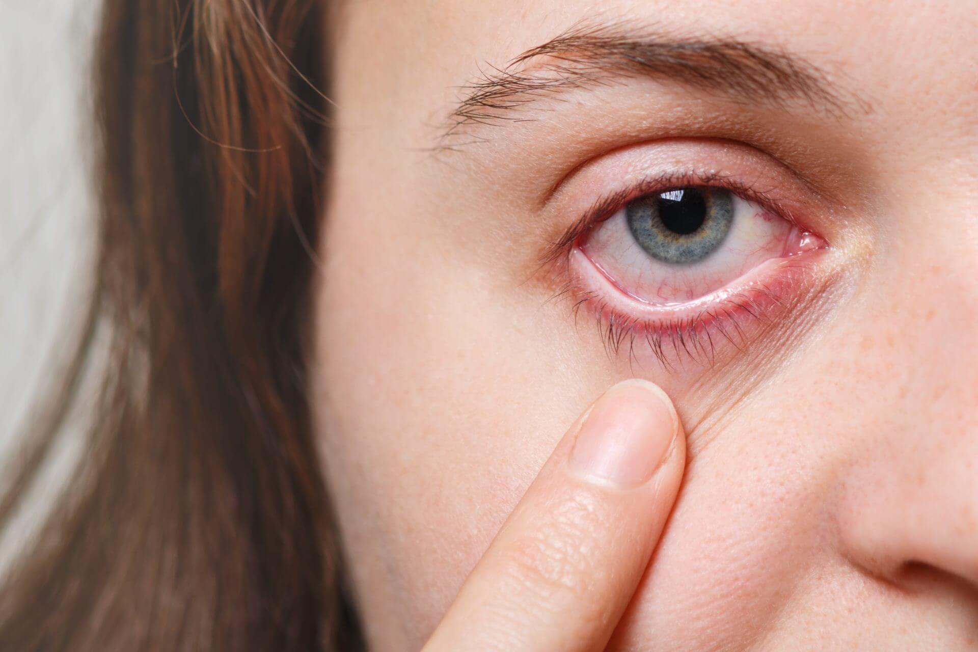 using hyaluronic acid for dry eyes