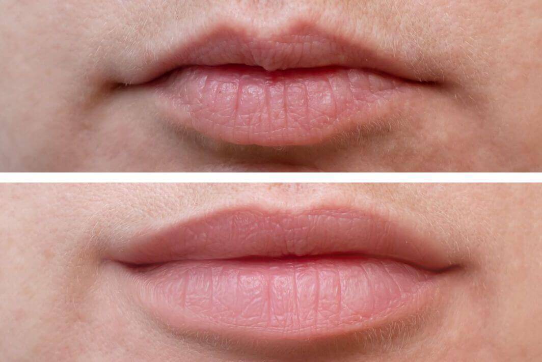 dermal filler immediate changes