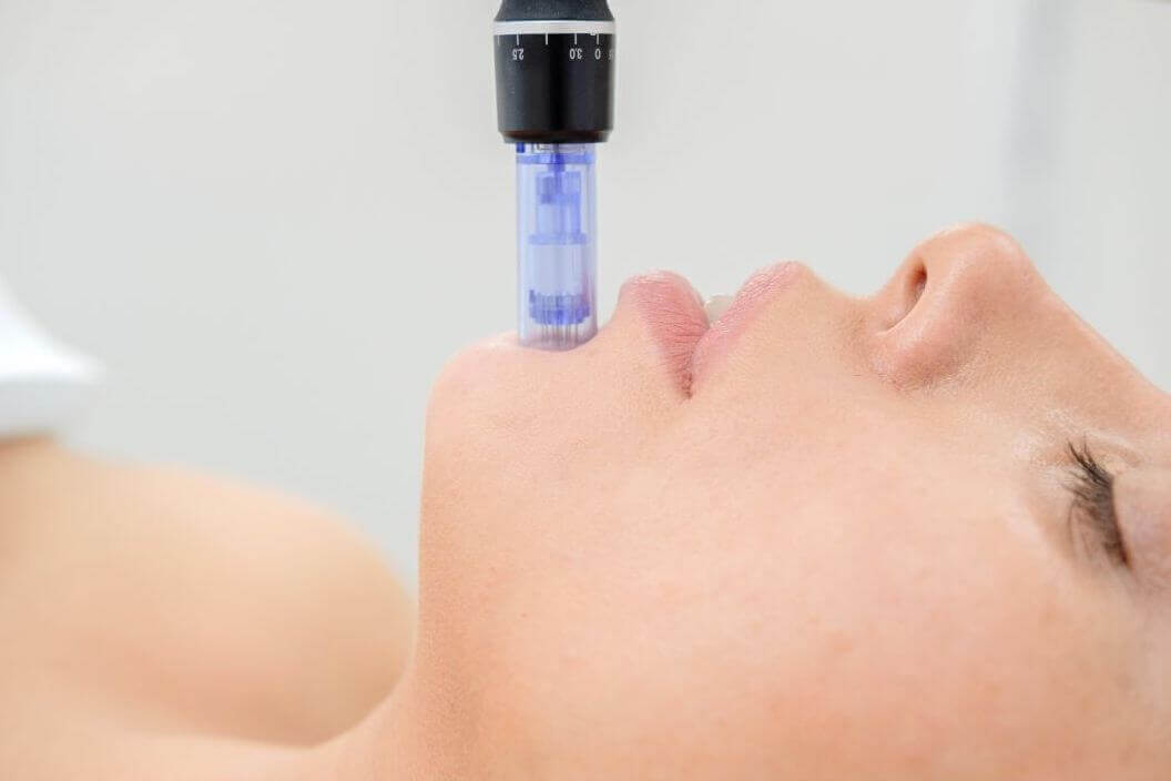 microneedling