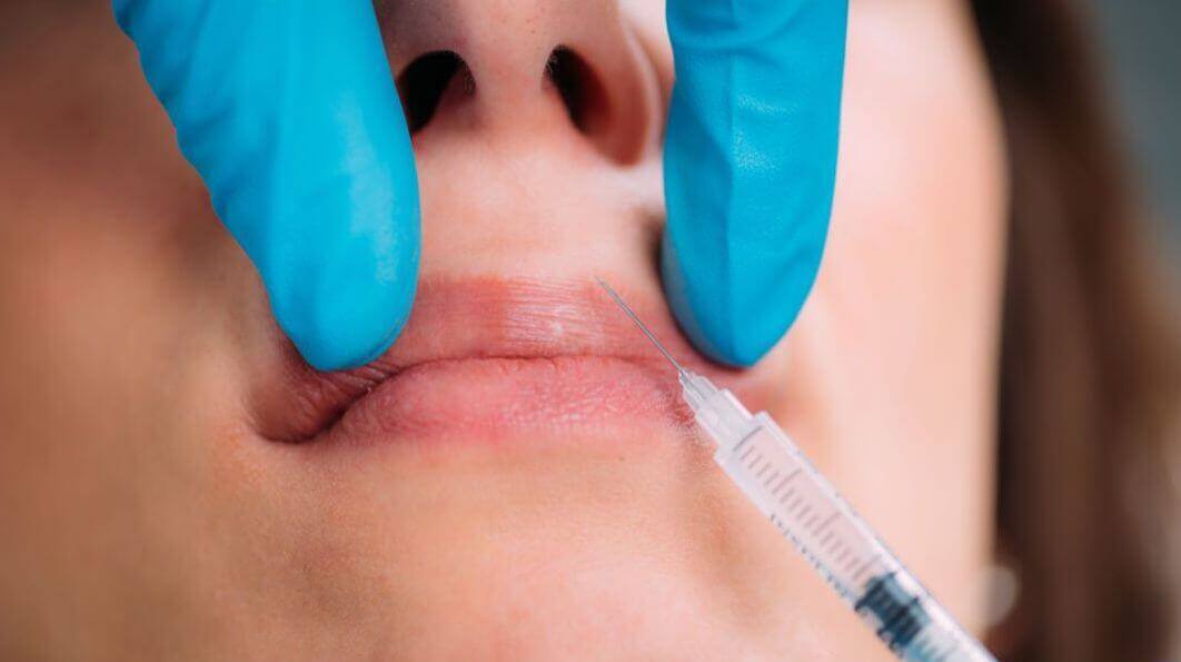 target areas of dermal fillers