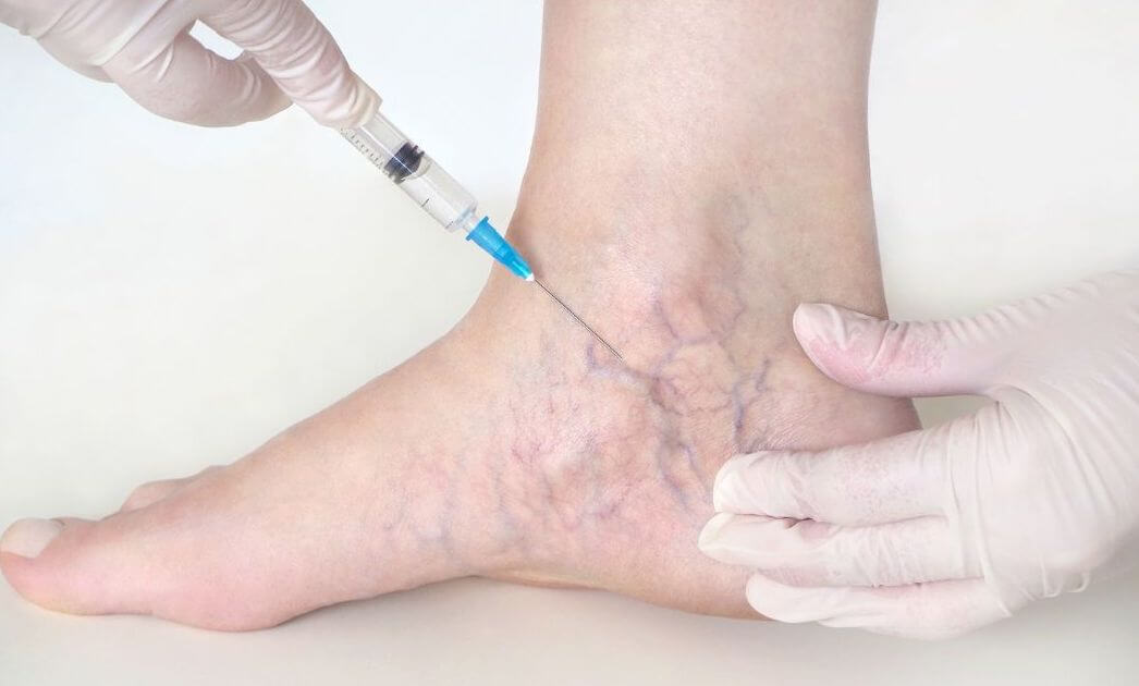 botox injections for foot pain