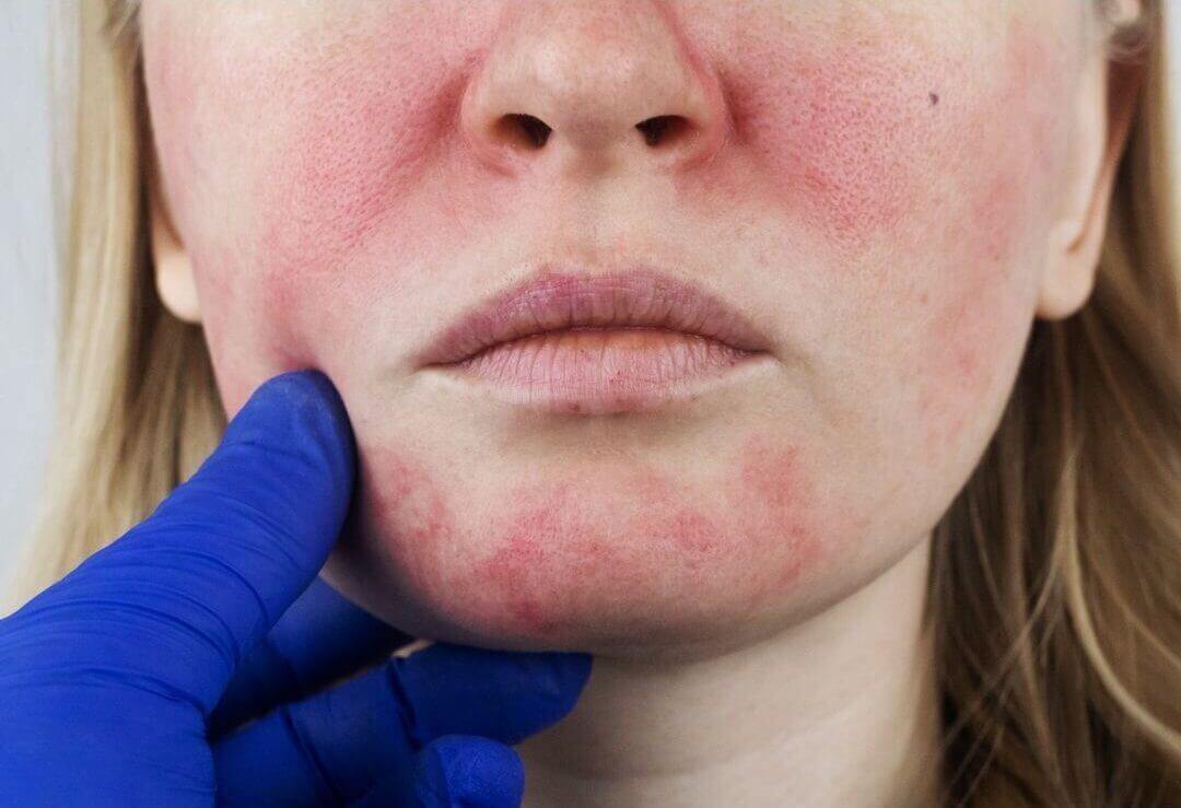 rosacea in winter