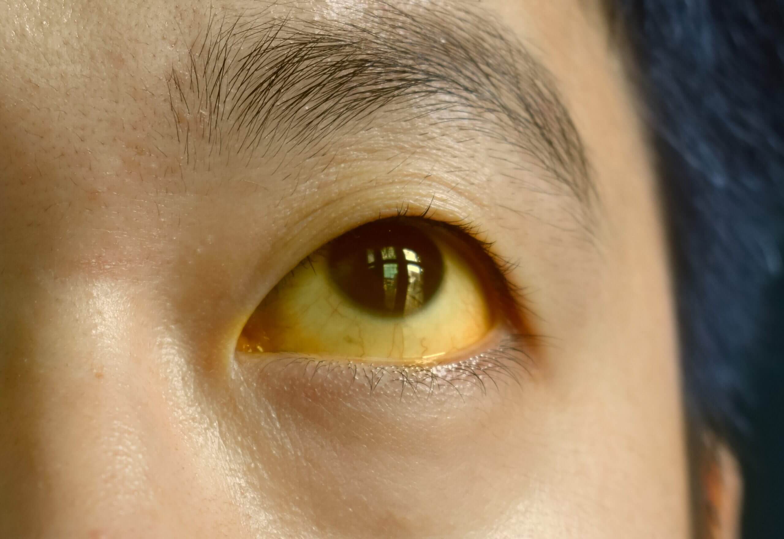 yellow eyes from trulicity