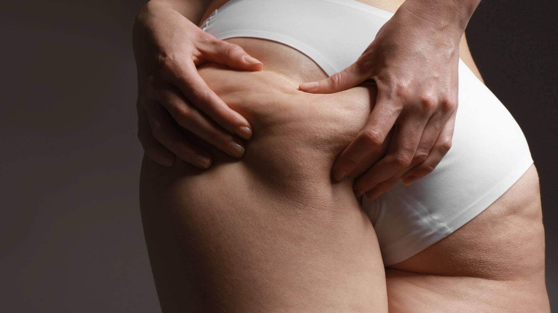 Cellulite Causes