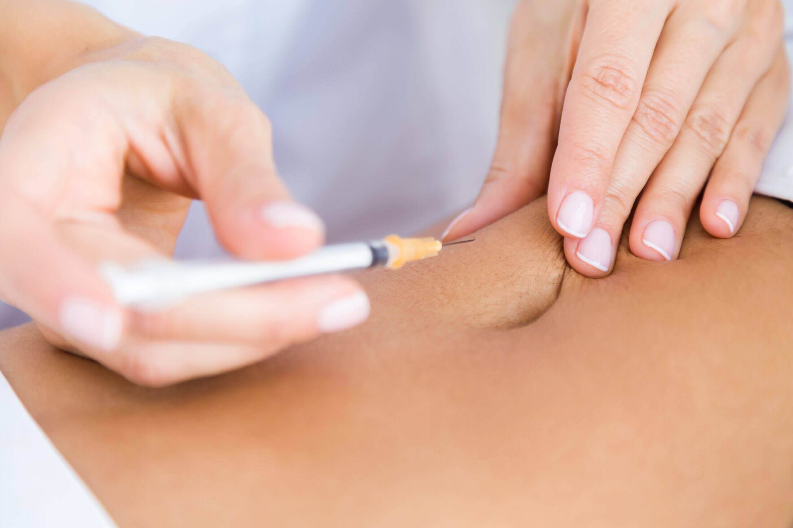 Microneedling