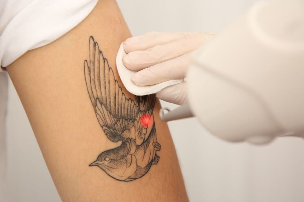 male tattoo removal