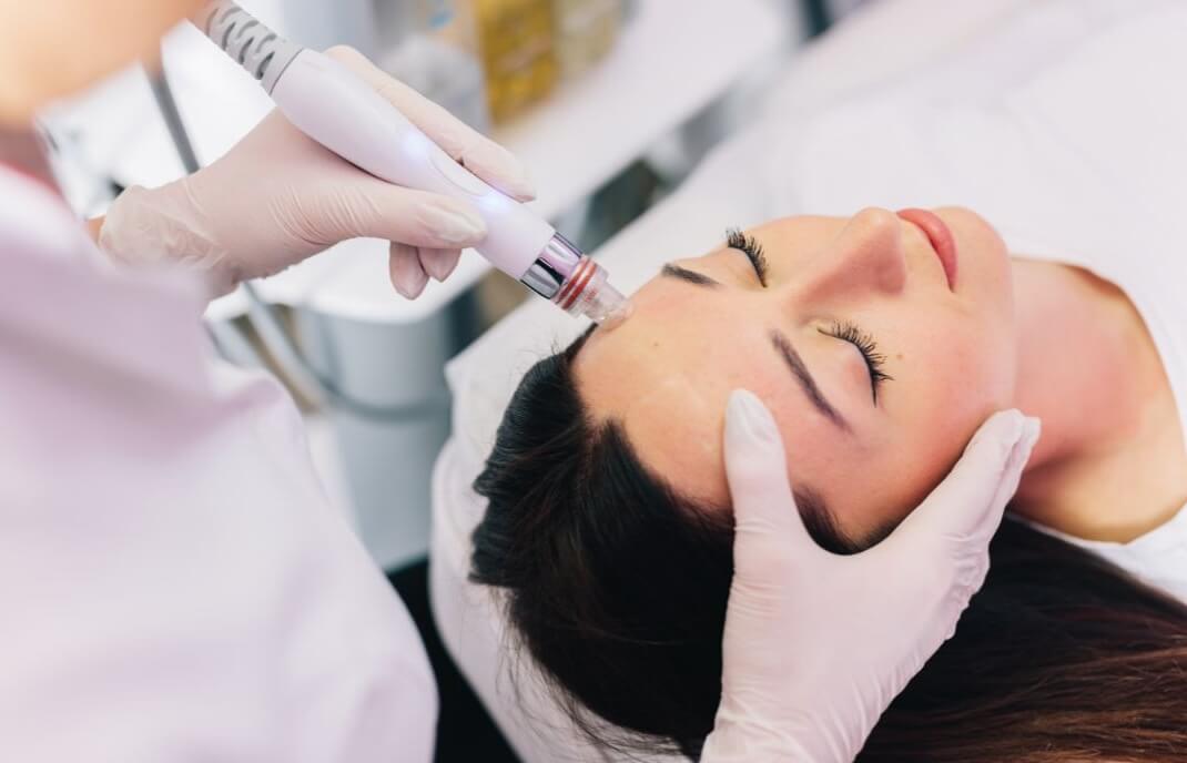 woman having microneedling