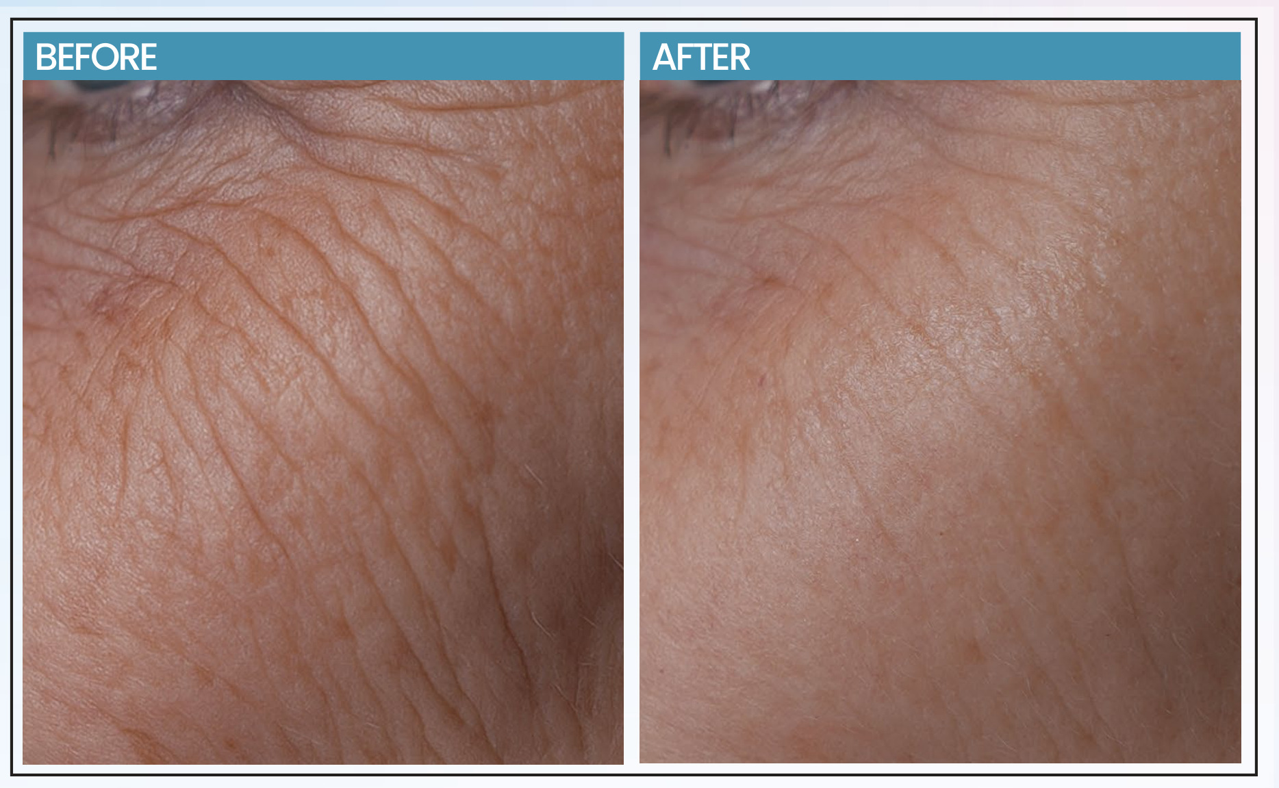 Before and after comparison photographs of skin treated with ALURA ELTOX Reverse Serum