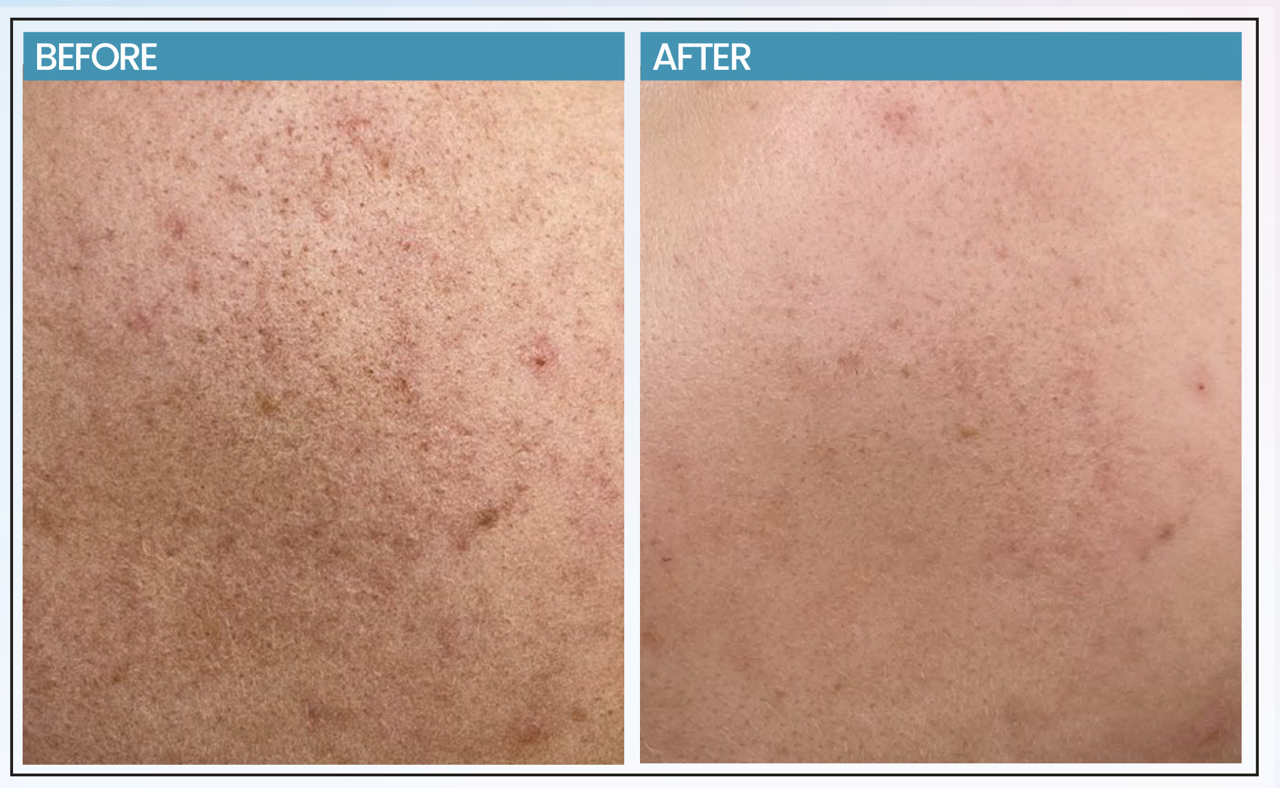 Before and after comparison photographs of skin treated with ALURA Glutathione Repair Serum