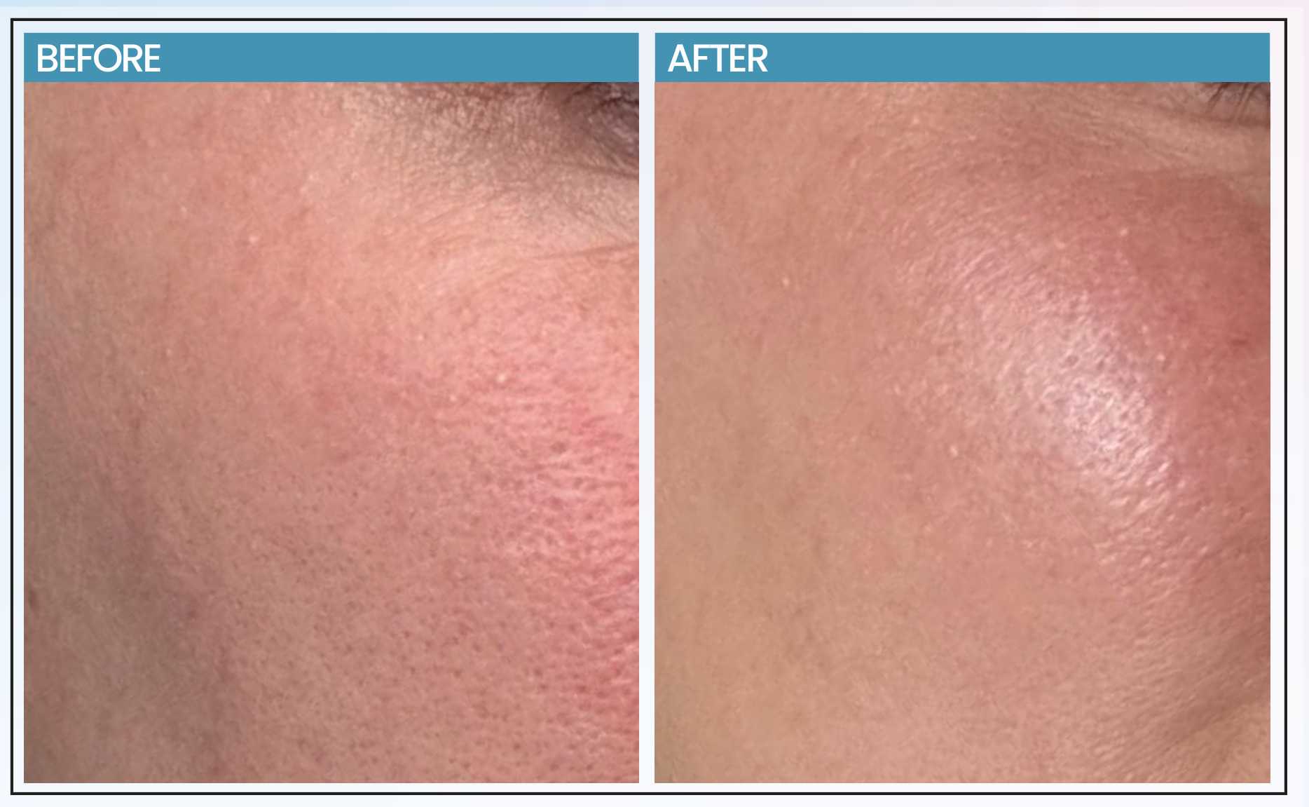 Before and after comparison photographs of skin treated with ALURA HA Revitalise Serum